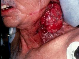 Bogazda Tumor